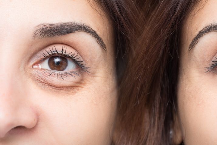 10 sintomi del cancro agli occhi 15