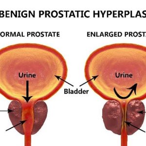 10 domande frequenti sull’ingrossamento benigno della prostata