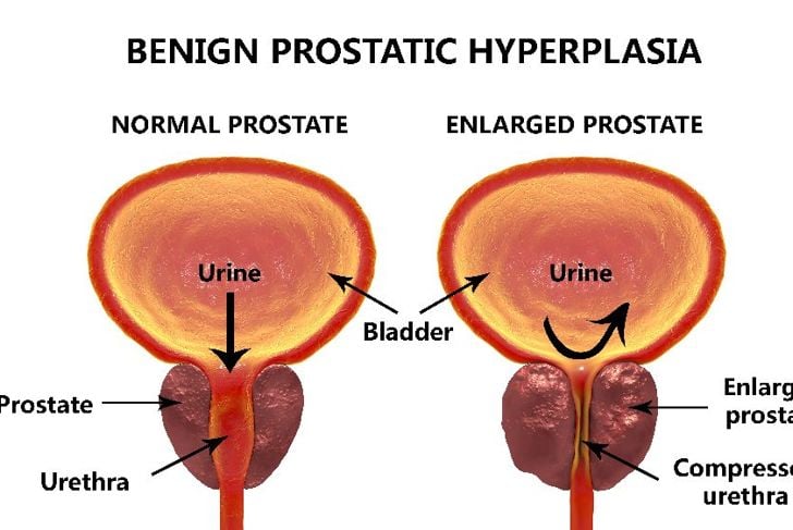 10 domande frequenti sull'ingrossamento benigno della prostata 1