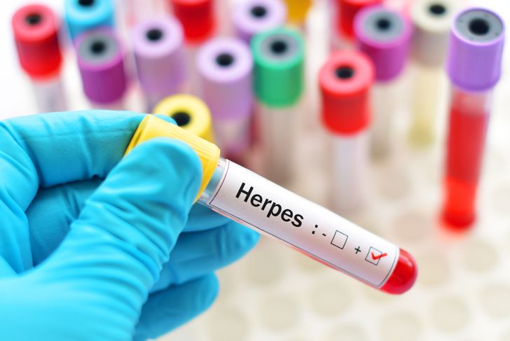 9 segni di herpes che non si possono ignorare 15
