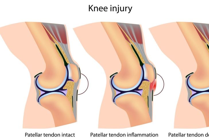 Le 10 cause più comuni di dolore al ginocchio 11