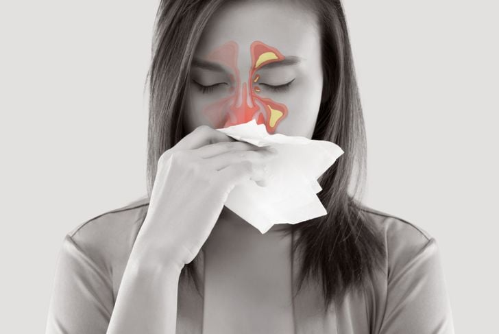 Sintomi dei polipi nasali 3