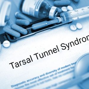 Che cos’è la sindrome del tunnel tarsale?