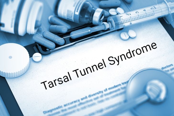Che cos'è la sindrome del tunnel tarsale? 1